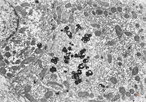 M,16y. | lipofuscin - hyperbilirubinaemia - Gilbert or Dubin-Johnson syndrome